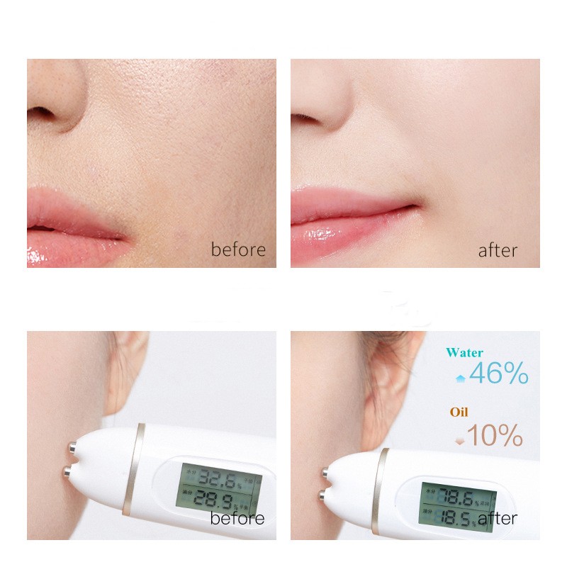 Liquid Thread Face Lifting Supplier - Hot Selling Self-Seal Sterilization Skin Tightening