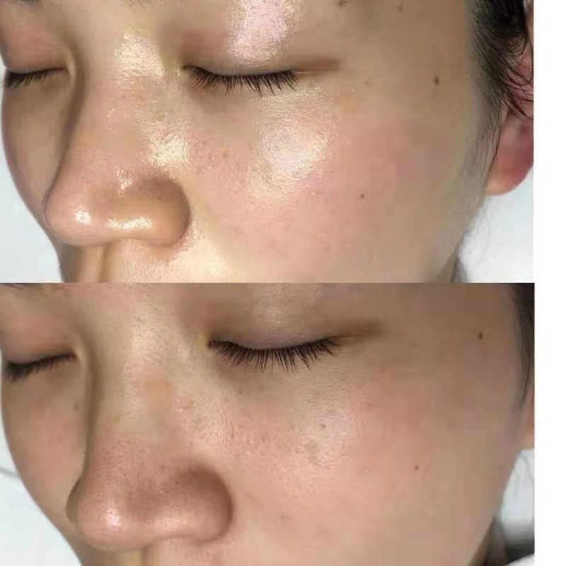 Extractor Lotion Factory - 350 ML/950ML Super Extractor Derived Lotion Blackhead Remover Serum