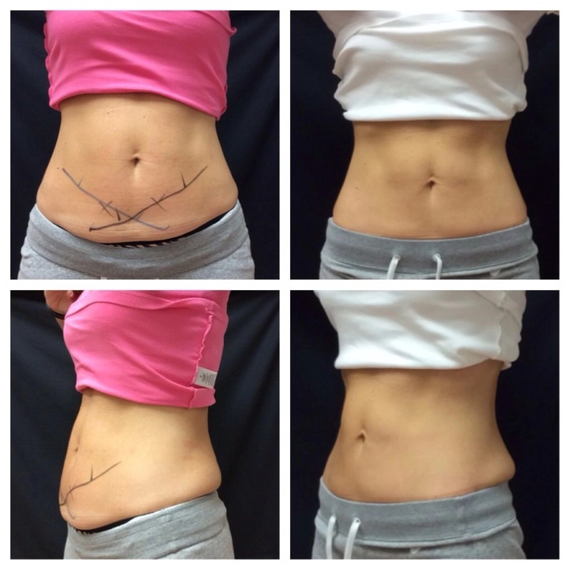 Fat Freezing Machine Manufacturer - Advanced Cryolipolyse Fat Freezing Cool Therapy Sculpting Machine