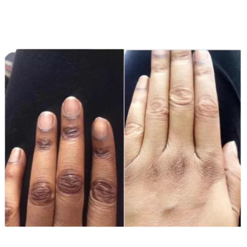 Scar Remove Oil Manufacturer - Extra Strong Peeling Oil Stretch Marks Solution