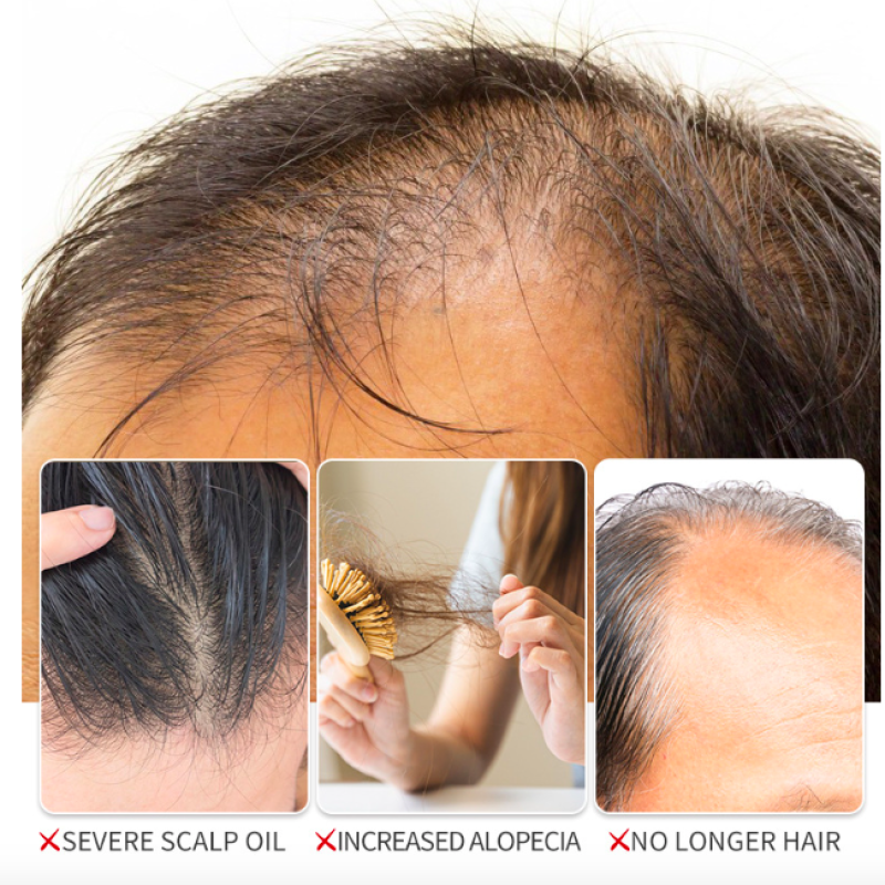 Hair Growth Serum Supplier - Hot Sale Quality Guaranteed Anti Fake 2025