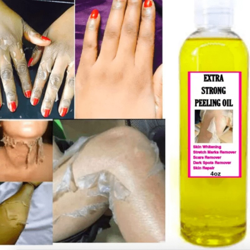 Scar Remove Oil Manufacturer - Extra Strong Peeling Oil Stretch Marks Solution