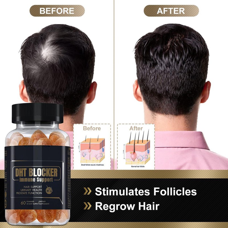 DHT Blocker Gummies Manufacturer - Saw Palmetto Biotin Prostate