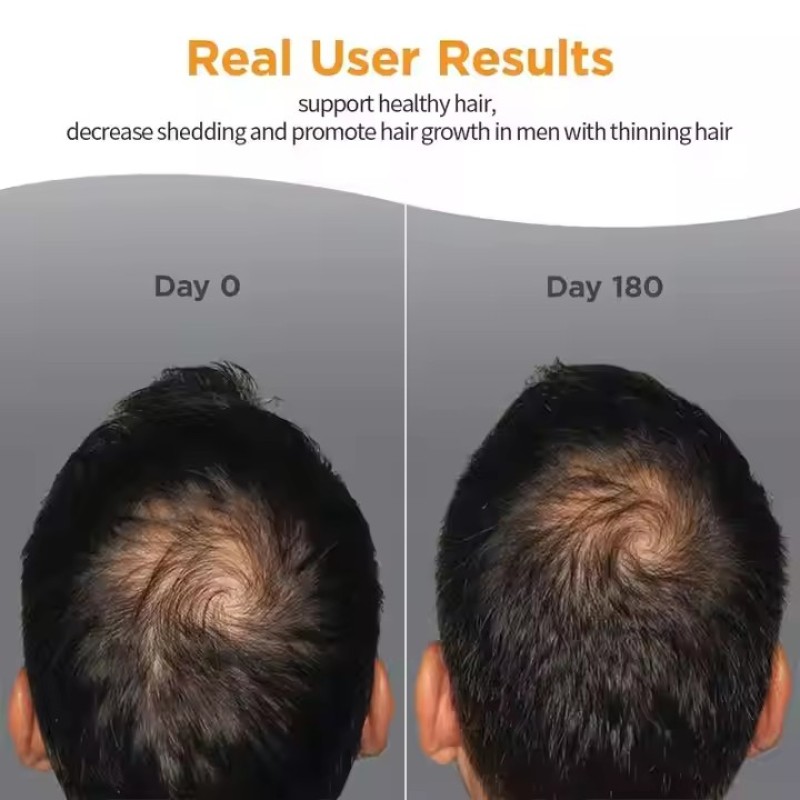 Men's Hair Growth Tablets Supplier - OEM/ODM Dietary Supplement for Sparse Hair