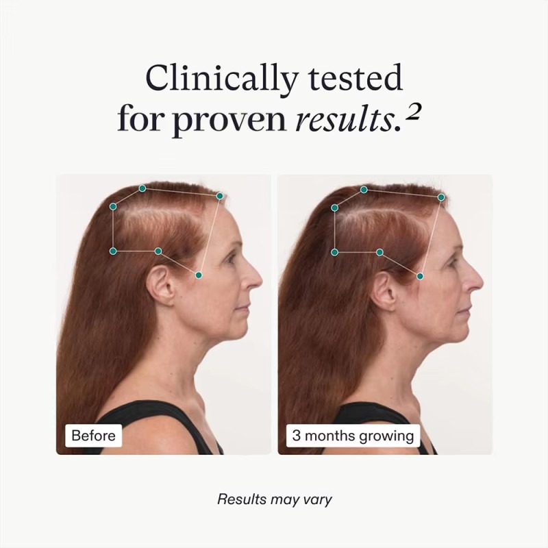 Hair Growth Supplement Supplier - Women Clinically Proven