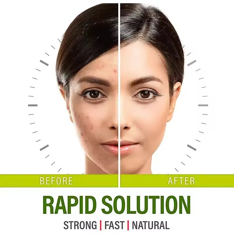 Acne Capsules Manufacturer - Vegan Skin Care Supplement