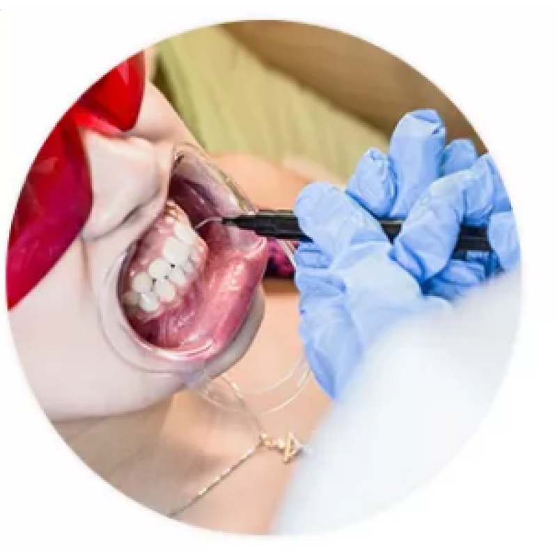 Gum Barrier Factory - Professional Teeth Whitening Protector