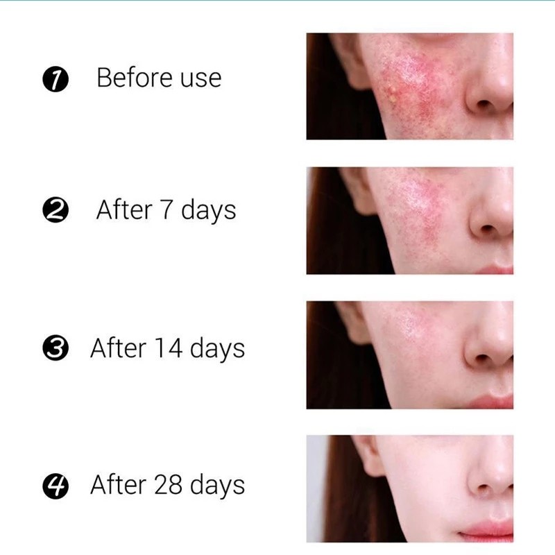 Acne Serum Factory - Private Label Salicylic Acid Removal