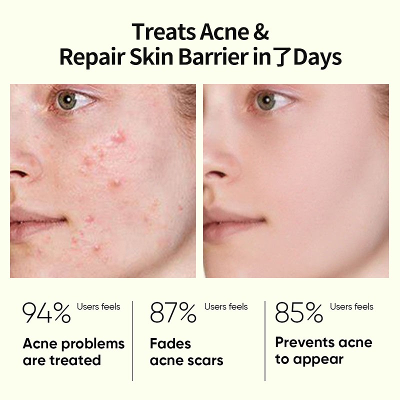 Acne Serum Factory - Private Label Salicylic Acid Removal