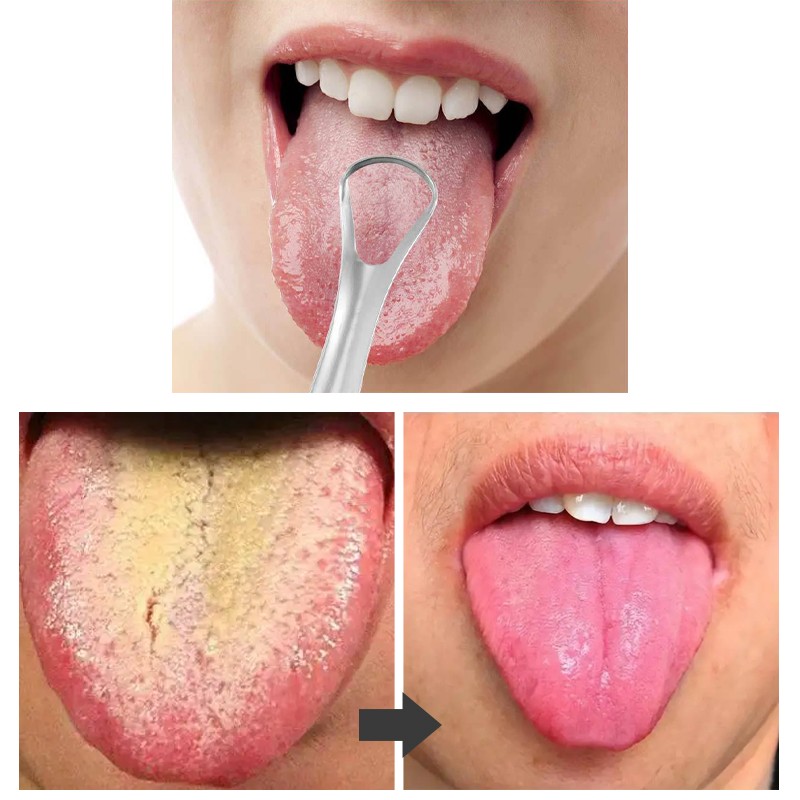 Tongue Scraper Factory - Free Samples U Shaped Steel