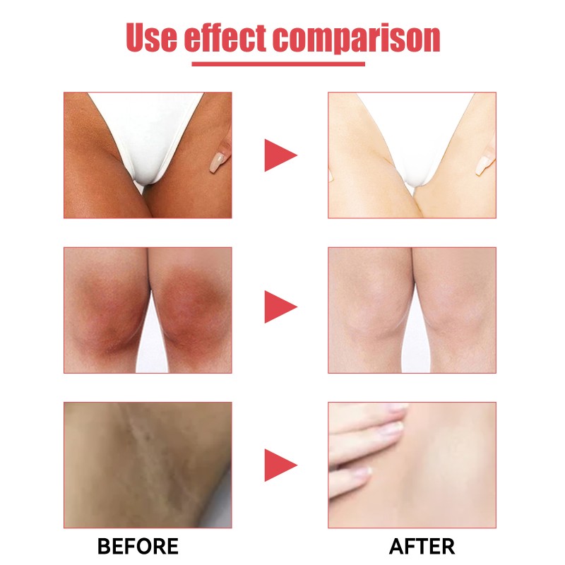 OEM Yoni Oil Private Skin Beautification Whitening Lotion  Black Skin Women Dark Knees Elbrow  Bleach Serum