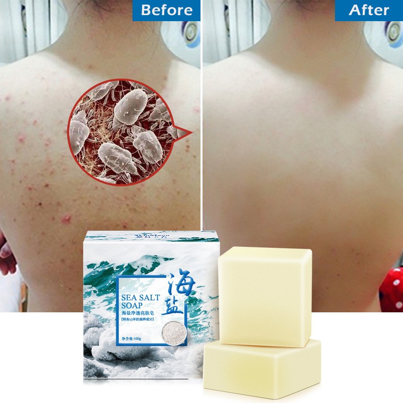 Acne Treatment Soap Manufacturer - 100g Pimple Pore Sea Salt Goat Milk Whitening