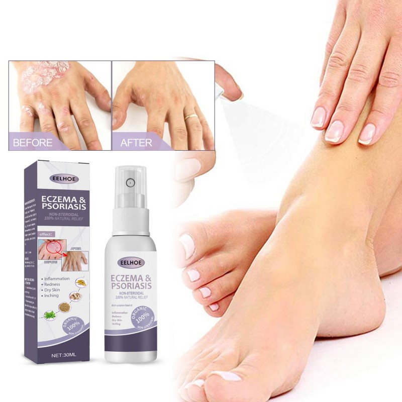 EELHOE Wholesale OEM Health Care Supplies Psoriasis Cream Eczema Herbals Spray for Skin Care