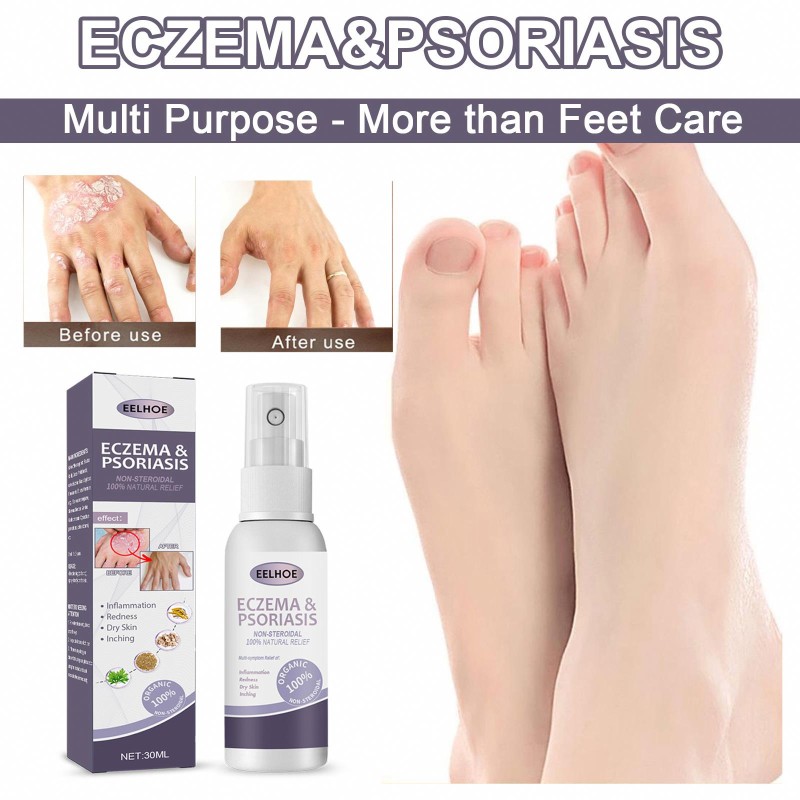 EELHOE Wholesale OEM Health Care Supplies Psoriasis Cream Eczema Herbals Spray for Skin Care