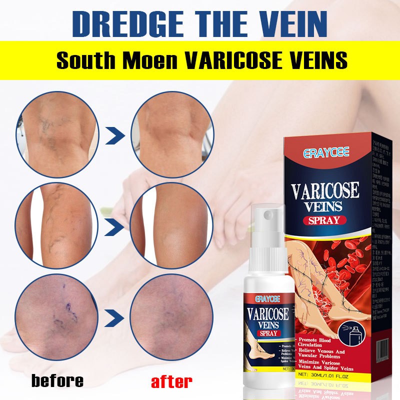 Varicose Vein Spray Vasculitis Phlebitis Spider Legs Soothing Blood Vessel Bulging Redness Leg Body Care Veins Spray