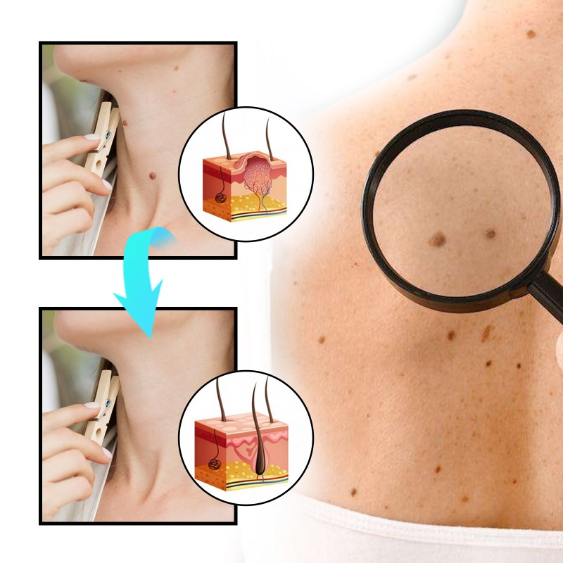 Wholesale Bee Venom Body Care Spray Effective Cure for Warts Moles and Desalination for Body Treatment