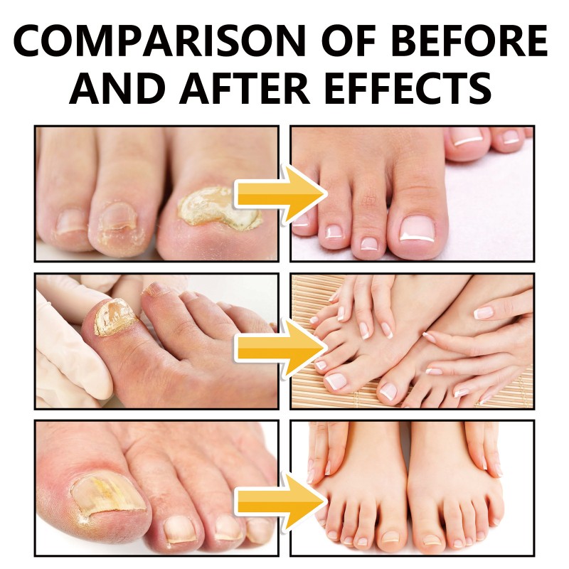 XIMONTH Nail Care Soothing Repairing Natural Nail Fungus Treatment Serum Spray 100ml