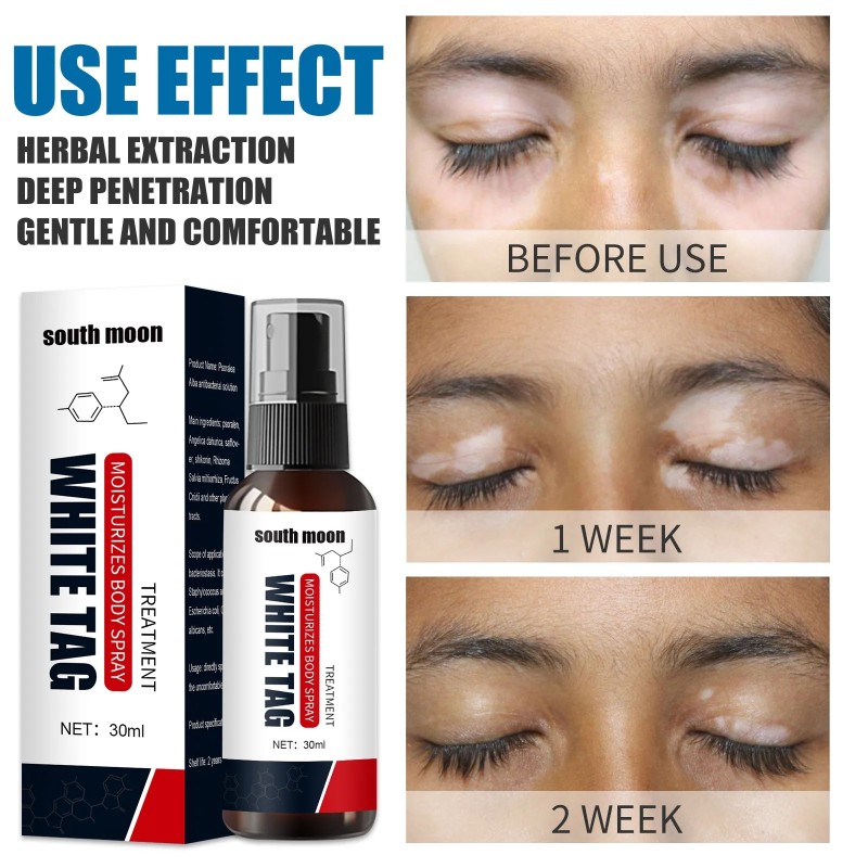 South Moon Vitiligo Spray Moisturizing White Spots Leukoplakia Disease Pigment Melanin White Tag Care