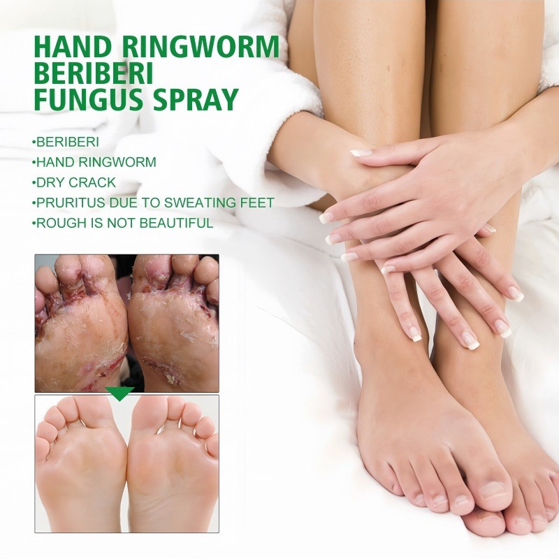South Moon Gentle Herbal Formula Antifungal Hand and Foot Care Spray 30ML for Ringworm Beriberi Fungus Treatment
