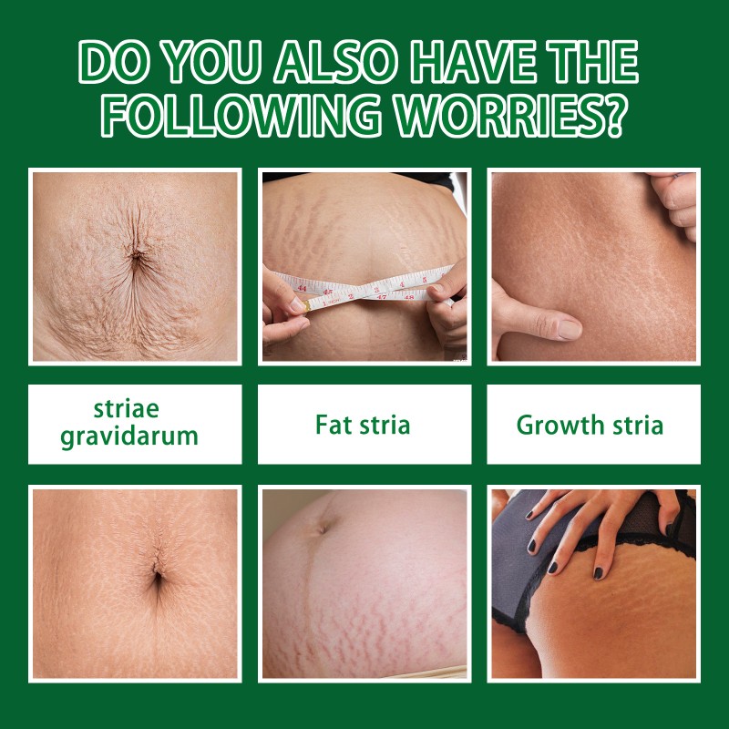 Stretch Mark Serum Supplier - Rose Removes Postpartum Obesity Repair