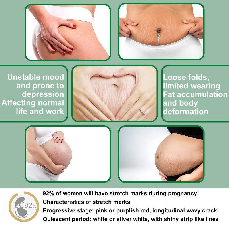 Stretch Mark Serum Supplier - Rose Removes Postpartum Obesity Repair