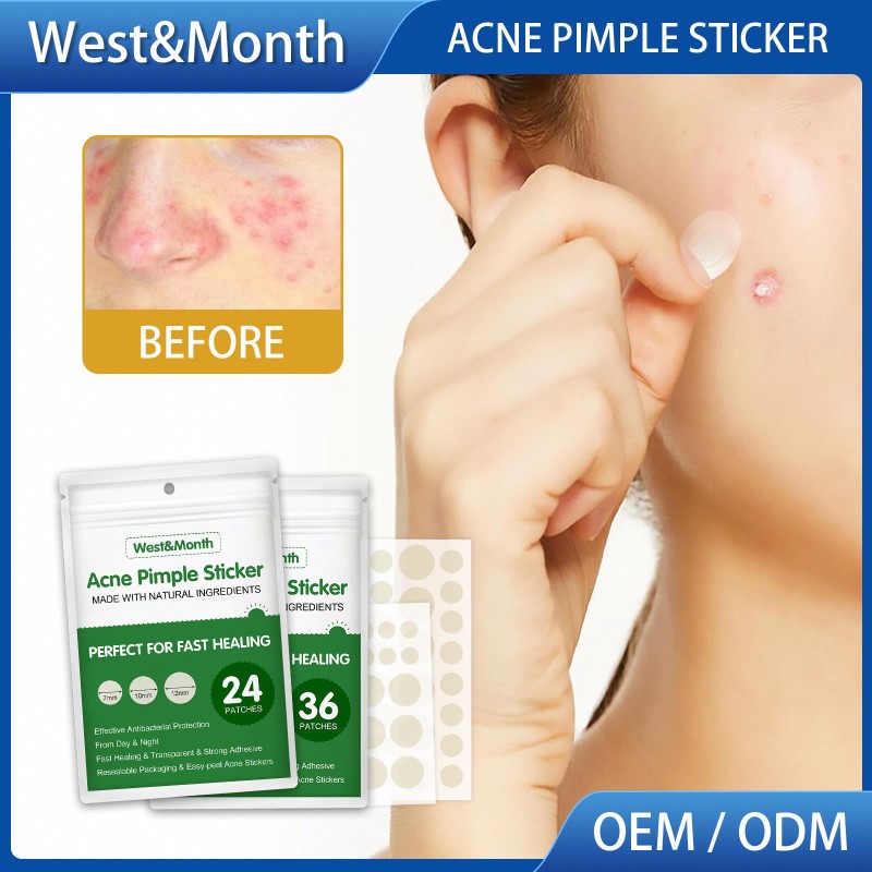 Acne Patch Factory - West&Month Acne Pimple Remover Waterproof Stickers