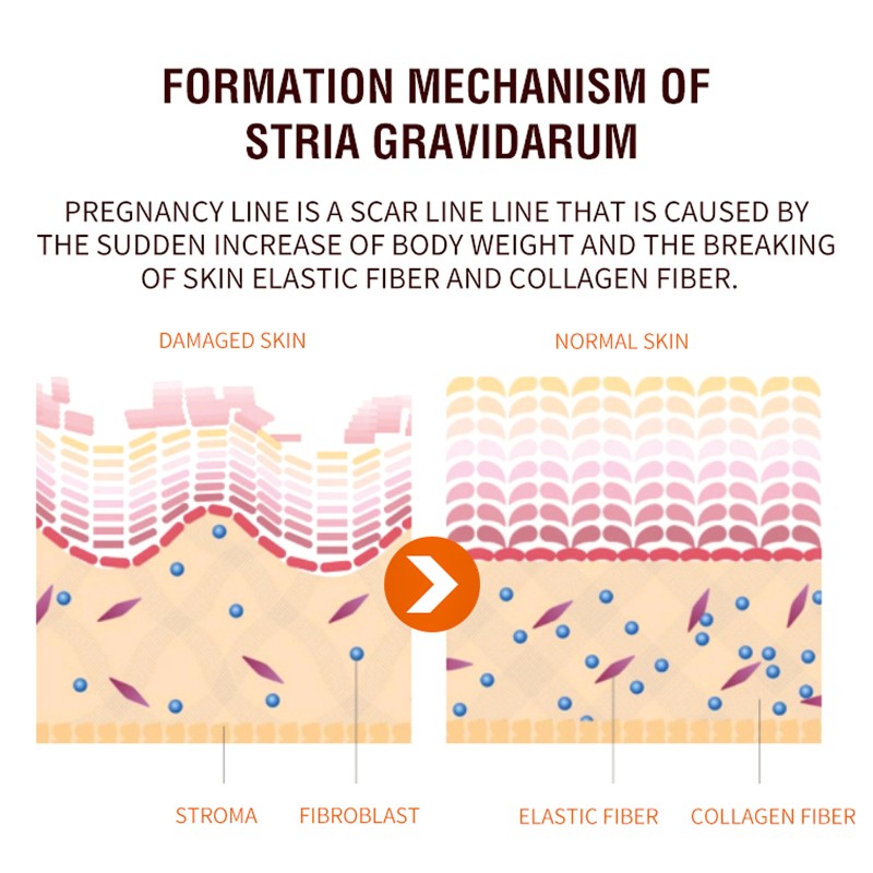 Stretch Mark Serum Supplier - Rose Removes Postpartum Obesity Repair