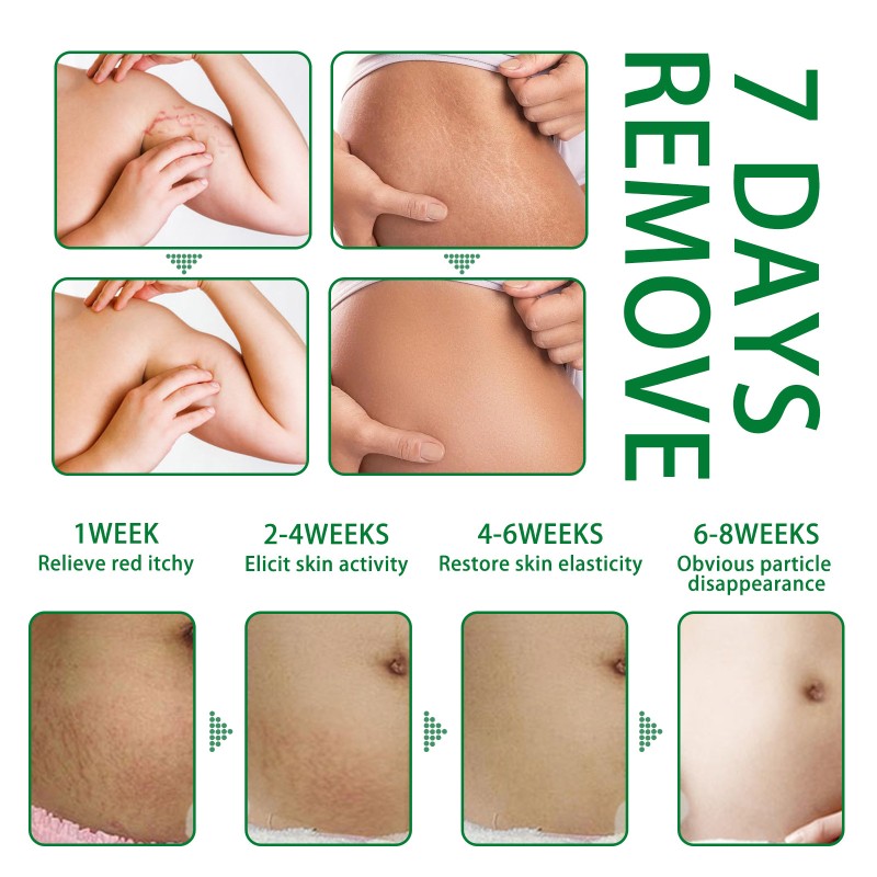Stretch Mark Serum Supplier - Rose Removes Postpartum Obesity Repair
