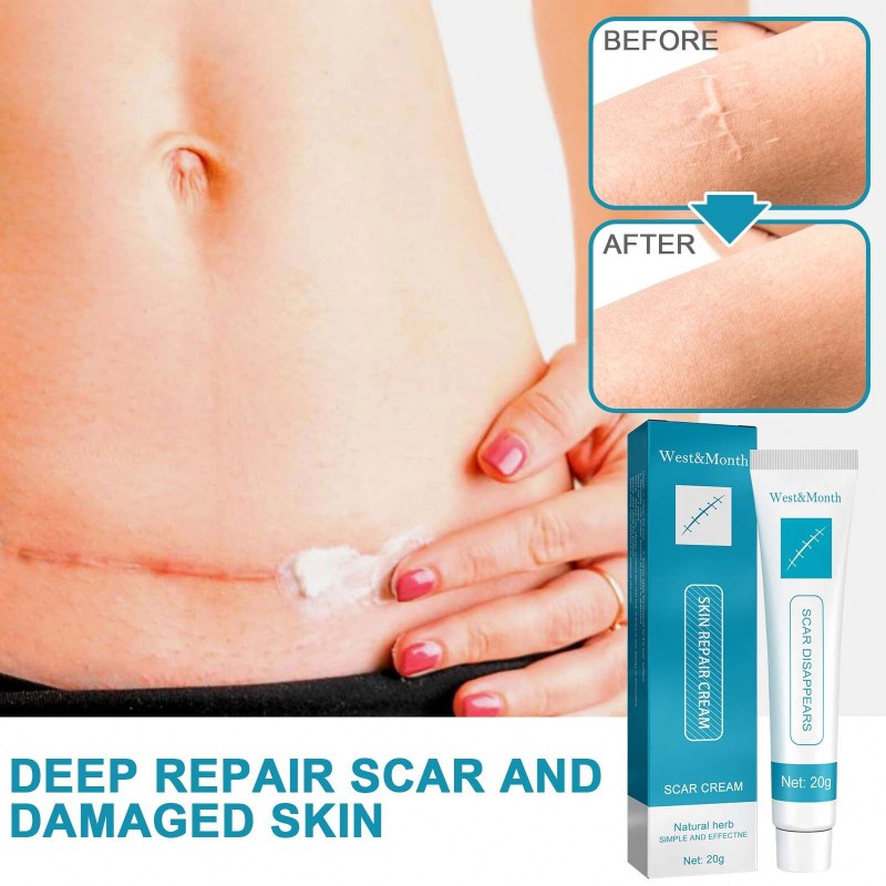 Scar Removal Cream Factory - West&Month Oem Scar Removal Pimples Marks