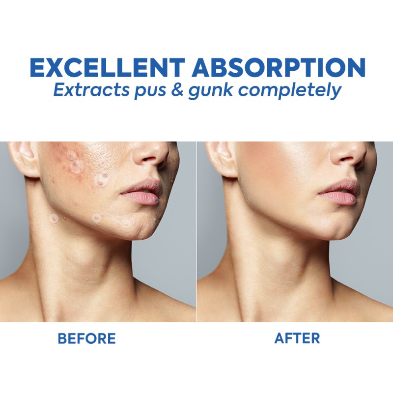 Acne Patch Manufacturer - New Item Hydrocolloid Healing Tea Tree