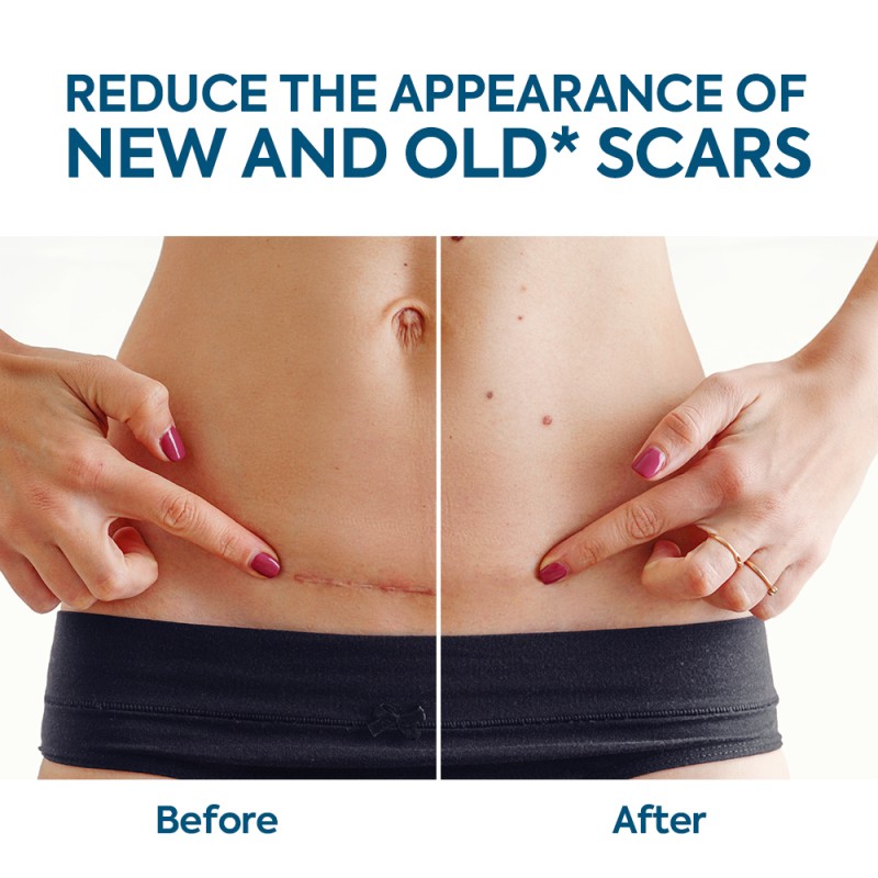 Silicone Scar Sheets Manufacturer - Low Price Removal Health Products