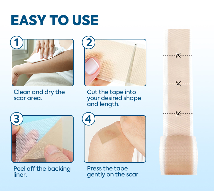 Silicone Scar Sheet